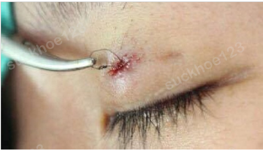 Lộ nút thắt chỉ, tuột chỉ sau khi tạo mắt hai mí