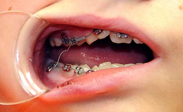Cách xử lý loét miệng khi đeo niềng răng