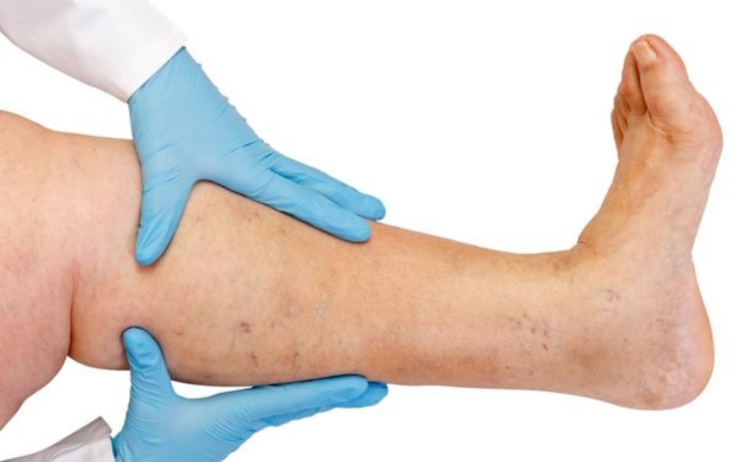 Loét tĩnh mạch và cách điều trị