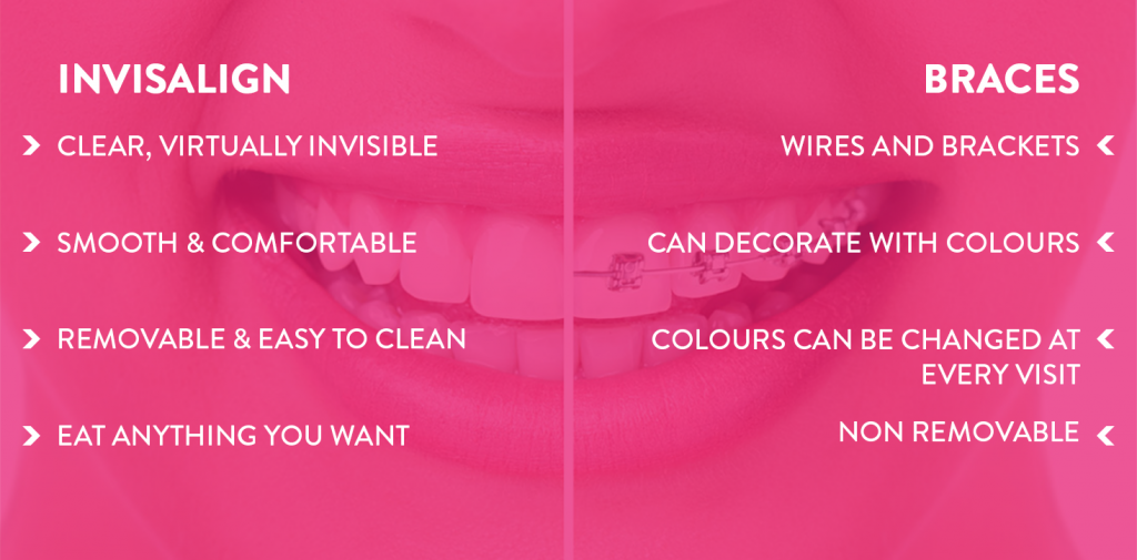 Lựa chọn niềng răng kim loại hay niềng răng trong suốt invisalign?
