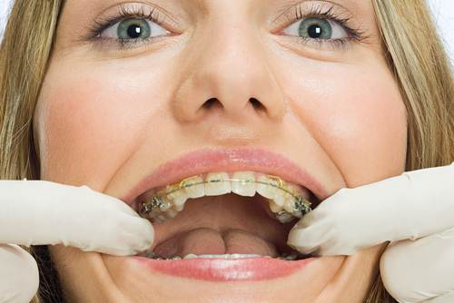Các lựa chọn niềng răng tốt nhất dành cho người lớn