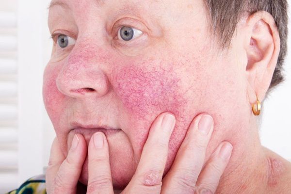 Mãn kinh có ảnh hưởng đến bệnh trứng cá đỏ không?