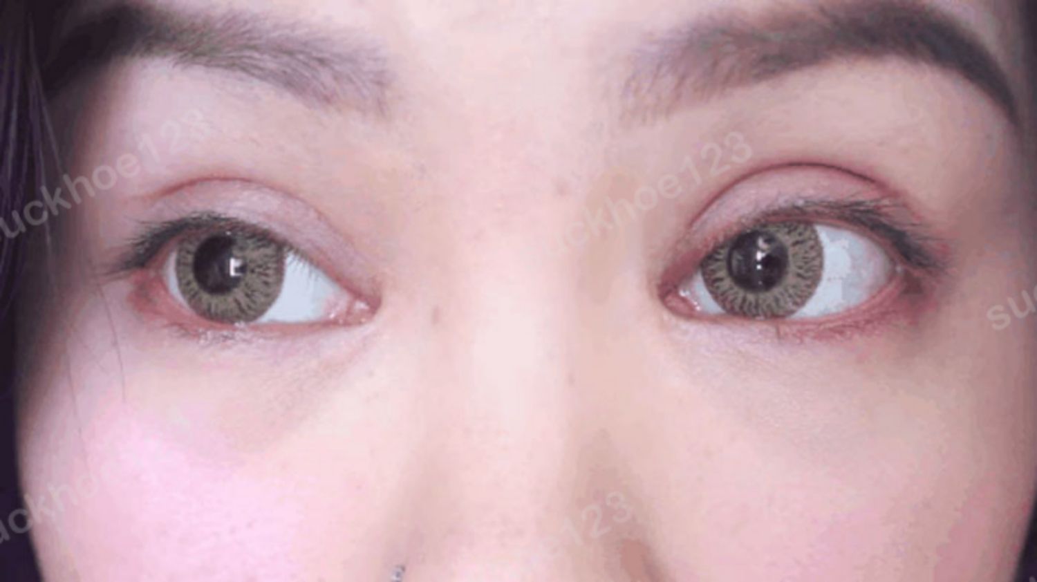 Cắt mí mắt bị trợn nguyên nhân do đâu, có sửa được không?