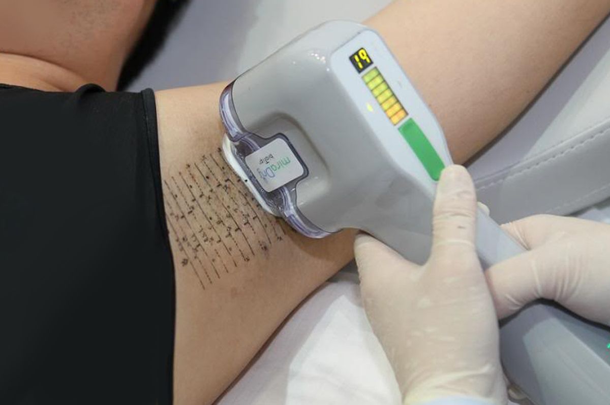 MiraDry điều trị tăng tiết mồ hôi nách