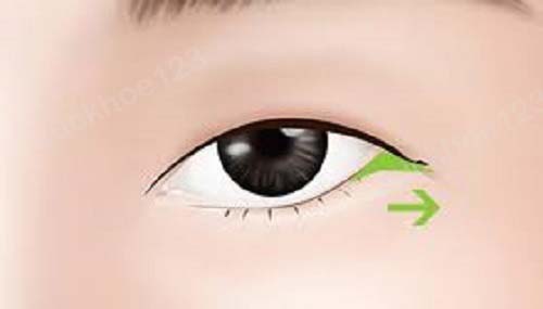 Các biến chứng sau mở góc mắt ngoài