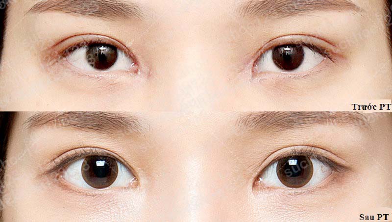 Mở Góc Mắt Trong