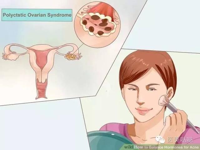 Mụn trứng cá do buồng trứng đa nang và nội tiết