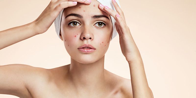 Nặn mụn đúng cách hay đi khám da liễu?