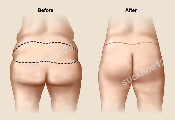 Nâng mông chảy xệ