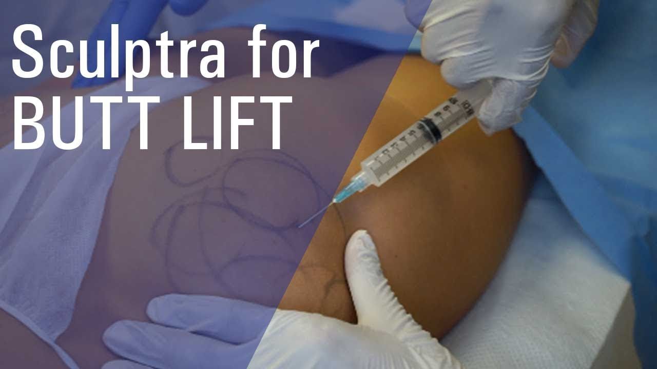 Nâng mông bằng tiêm filler Sculptra