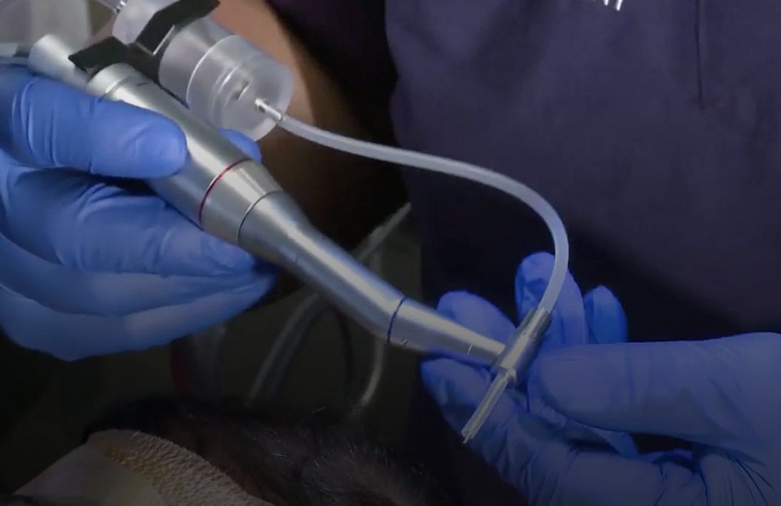 Thiết bị cấy tóc Neograft