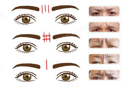 Các kỹ thuật xóa nếp cau mày (nếp nhăn giữa hai lông mày)