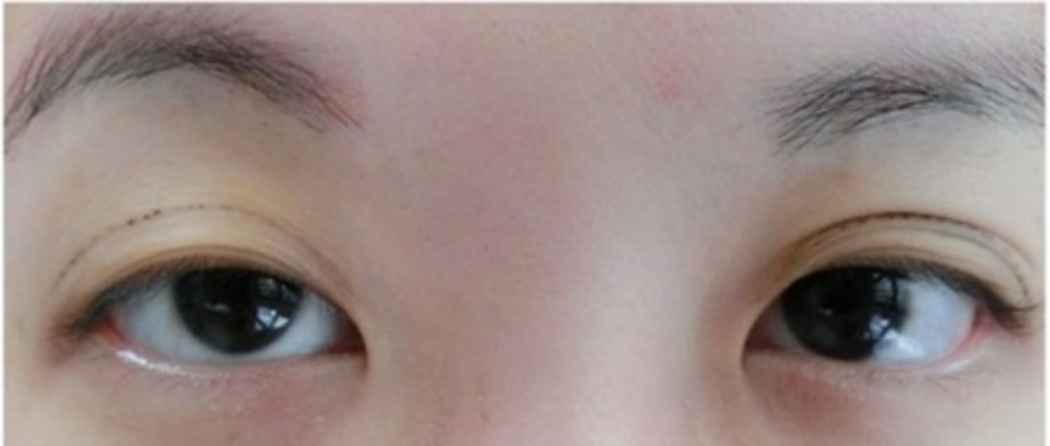 Cách Chữa Mí Mắt Không Đều