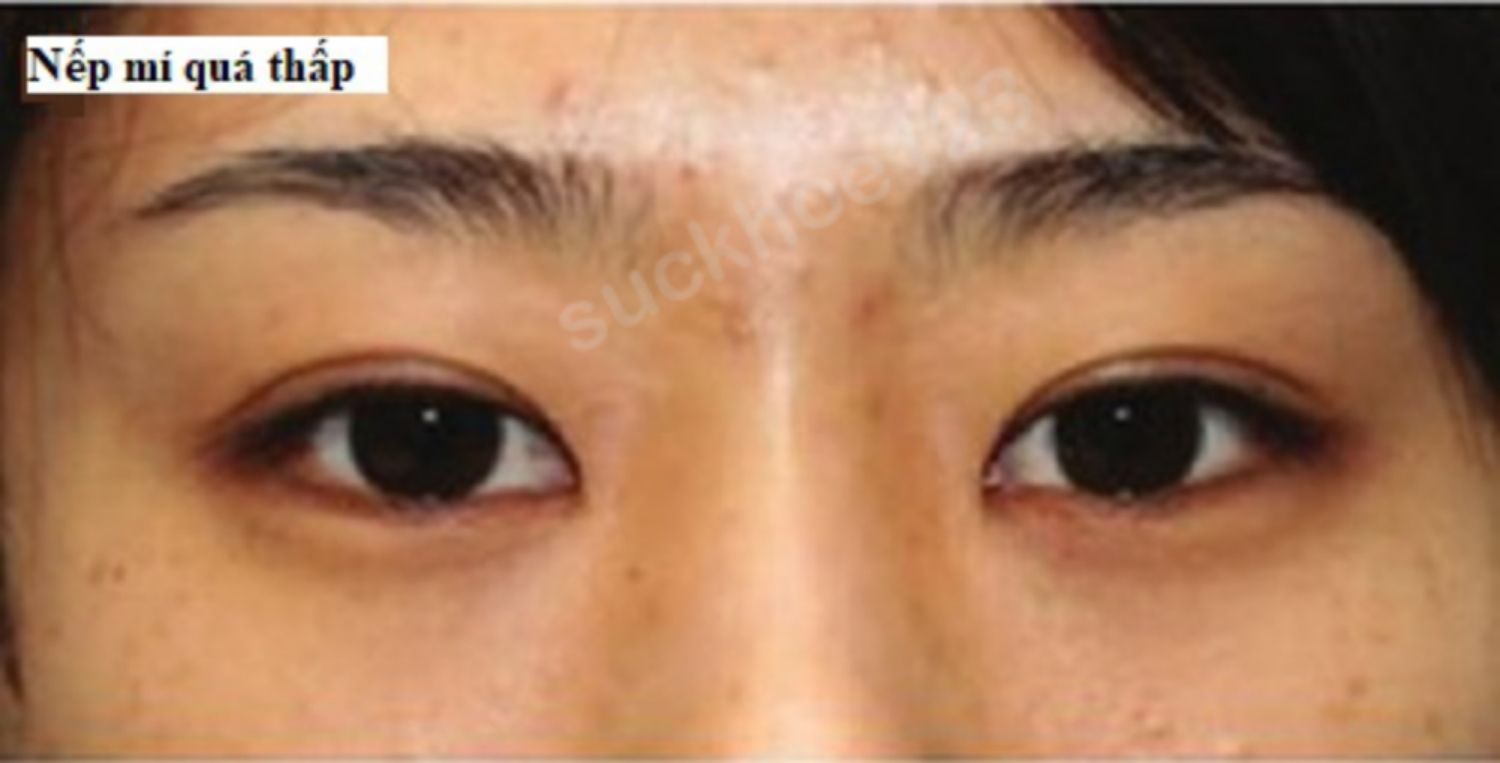 Nếp mí quá thấp sau phẫu thuật cắt mí