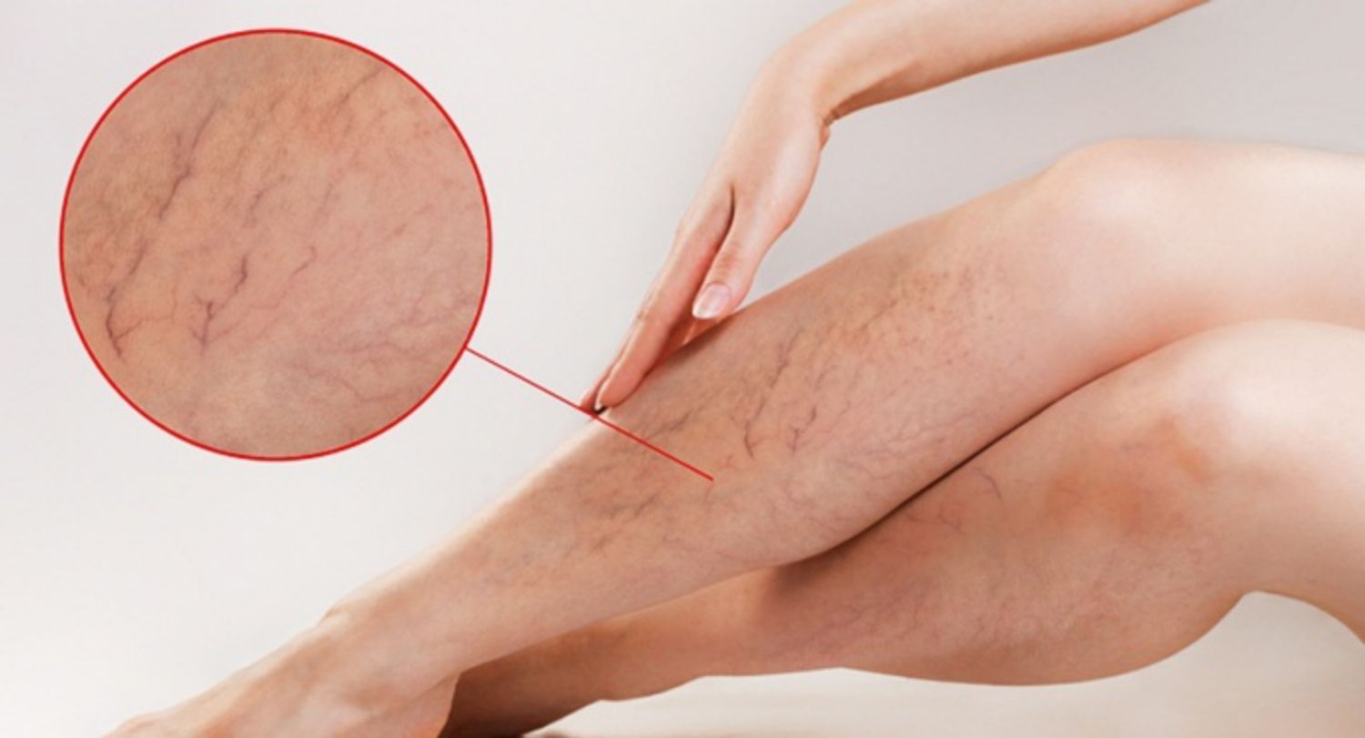 Giãn tĩnh mạch có nguy hiểm không?