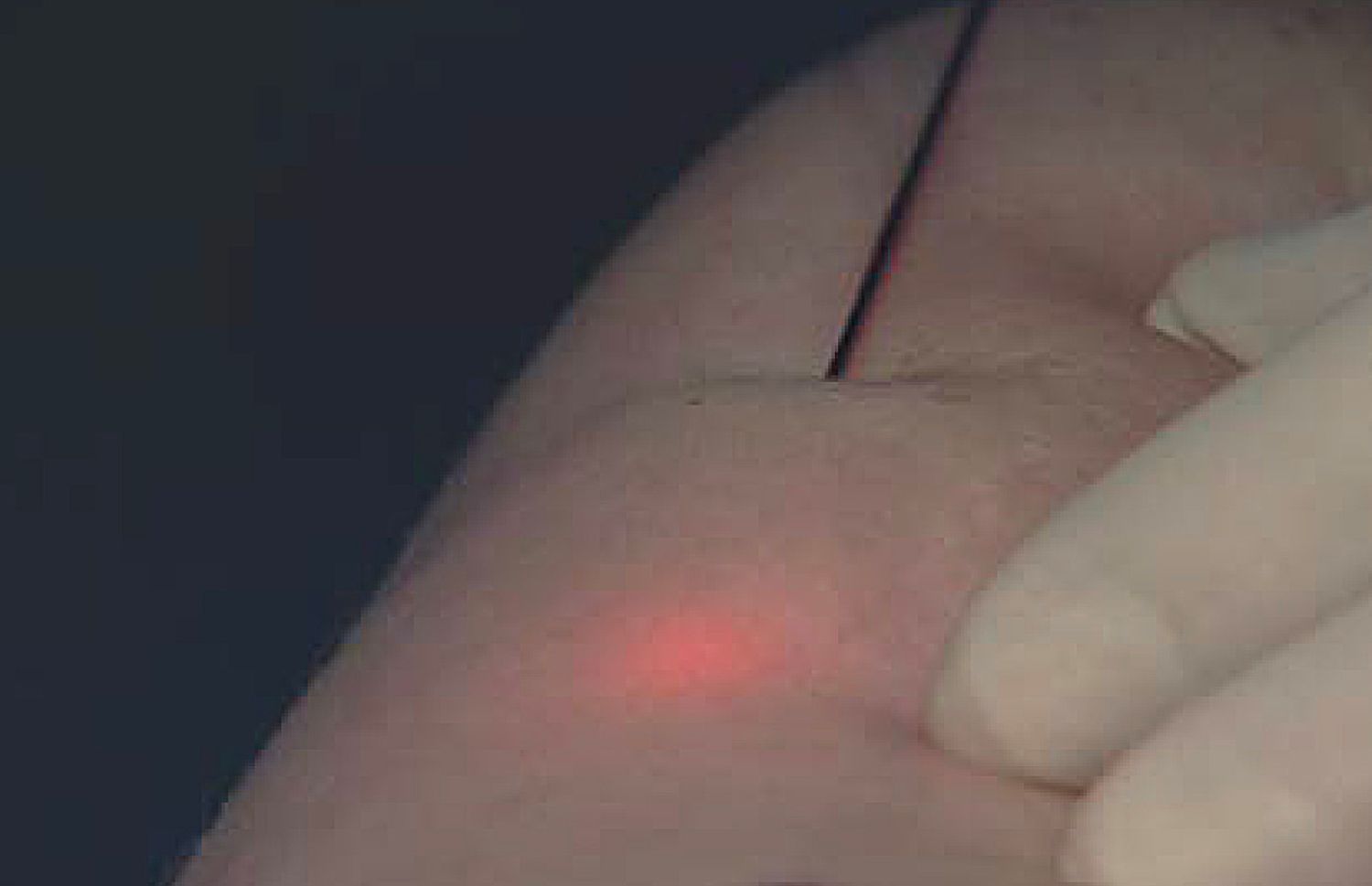 Nguyên lý hoạt động của hút mỡ công nghệ laser