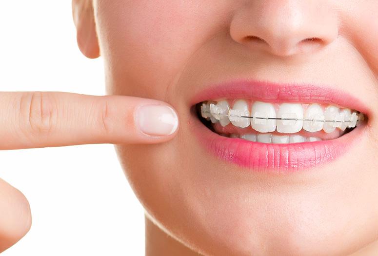Cần đeo niềng răng Damon trong bao lâu?