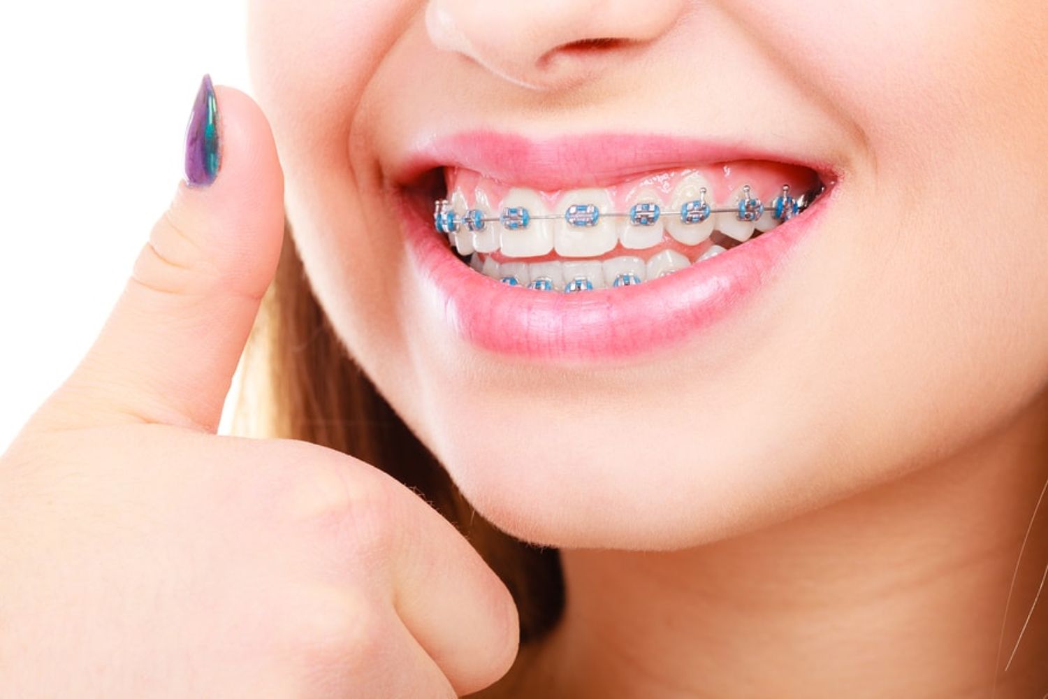 Một số cách giảm cảm giác khó chịu khi niềng răng