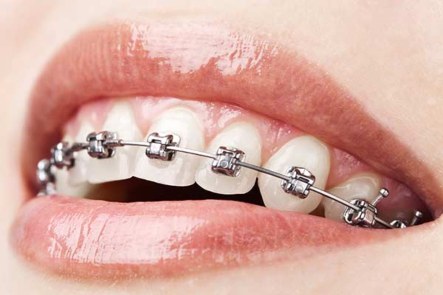 Niềng răng tự buộc là gì?