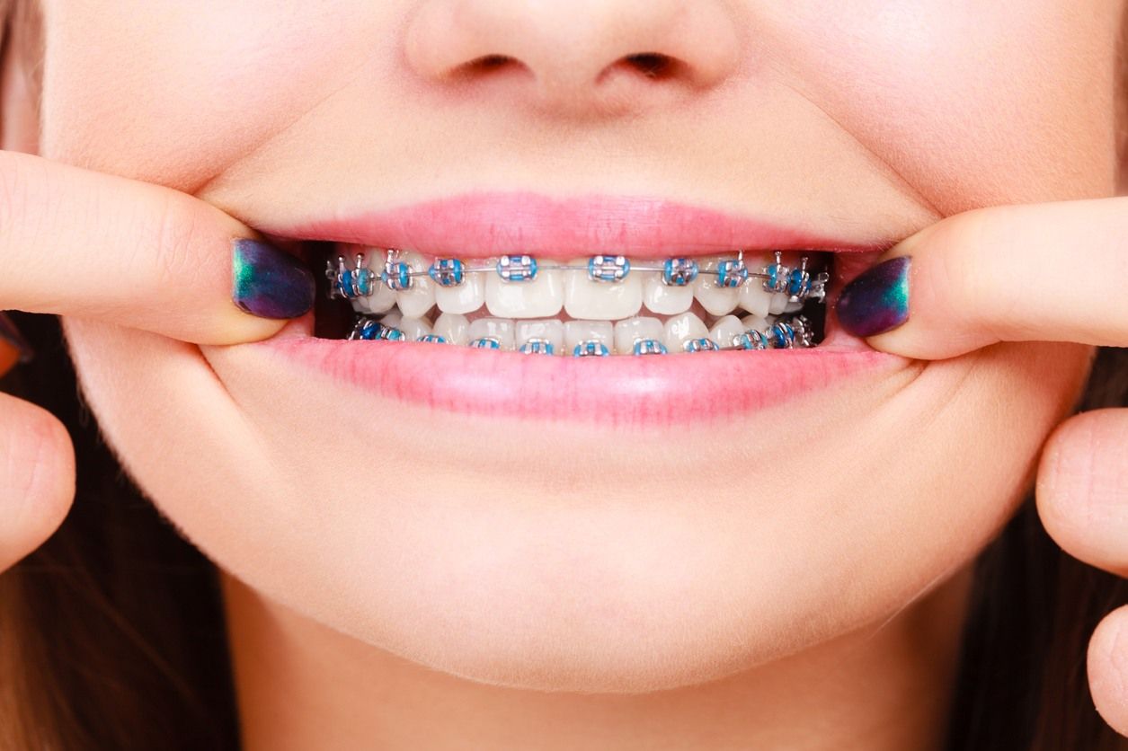 Niềng răng có những bộ phận nào?
