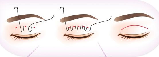 Bấm mí luồn chỉ tạo mắt hai mí