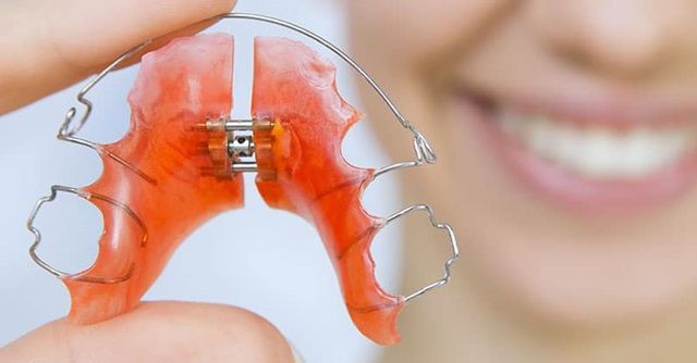 Có thể lắp khí cụ nong rộng hàm cho hàm dưới không?