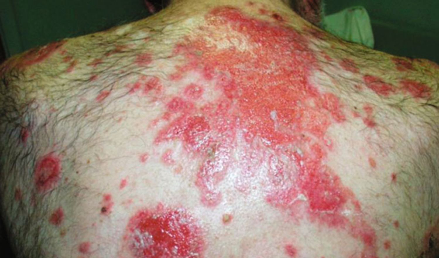 Pemphigus thể thông thường và trứng cá nặng