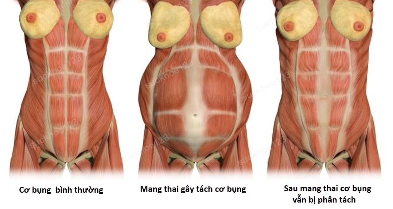 phan tach co bung do mang thai