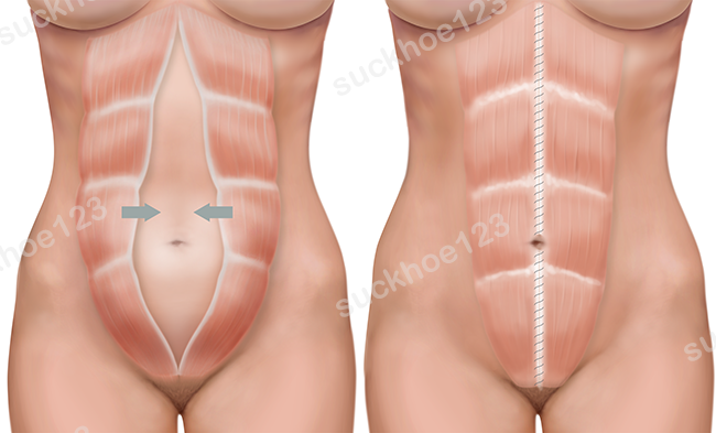 Chữa tách cơ bụng (xổ bụng sau sinh)