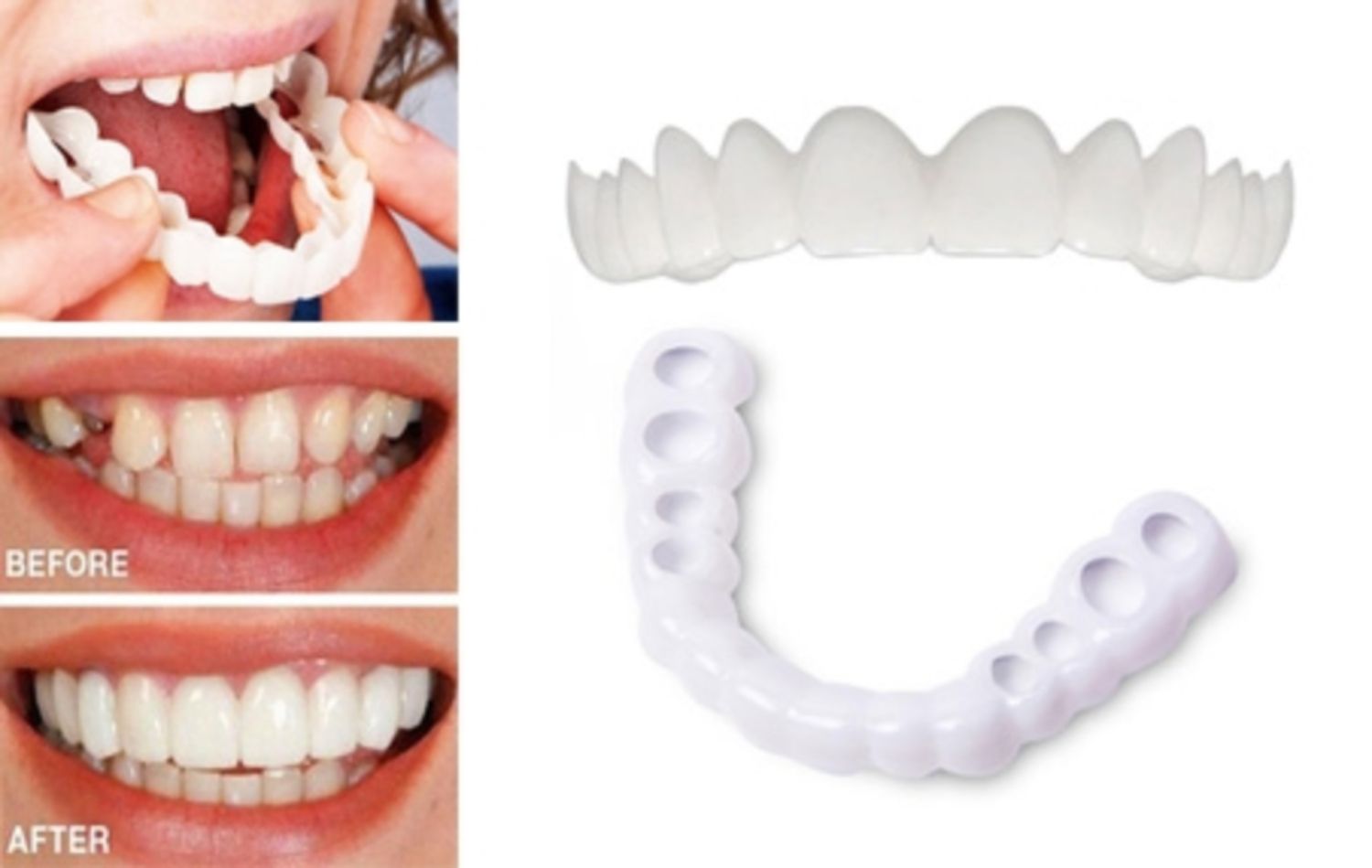 Răng giả Snap on smile