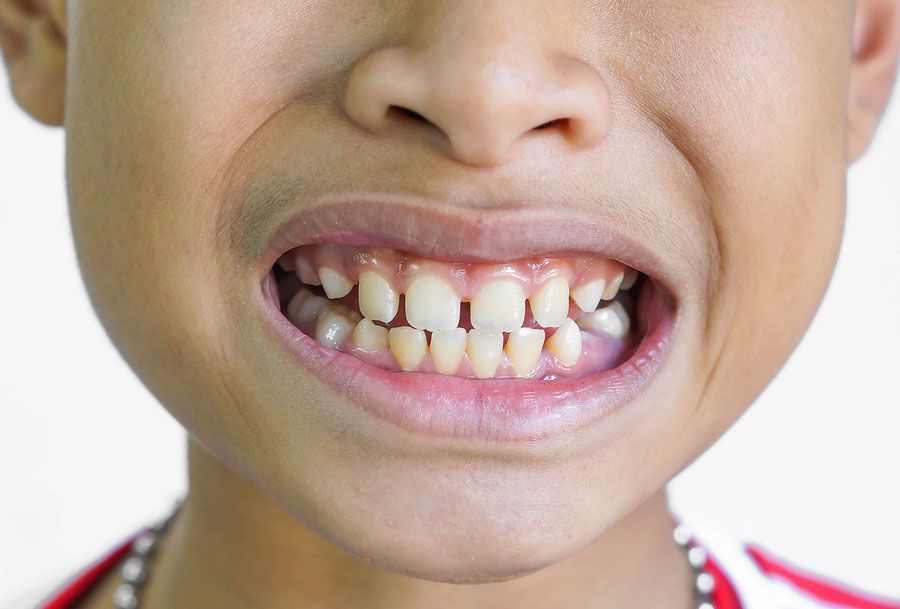 Răng thưa ảnh hưởng thế nào đến sức khỏe?