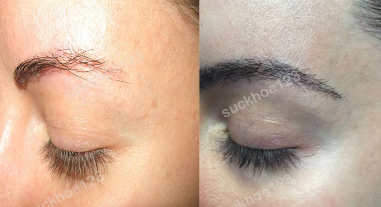 Nguyên Nhân Gây Rụng Lông Mày Và Cách Điều Trị