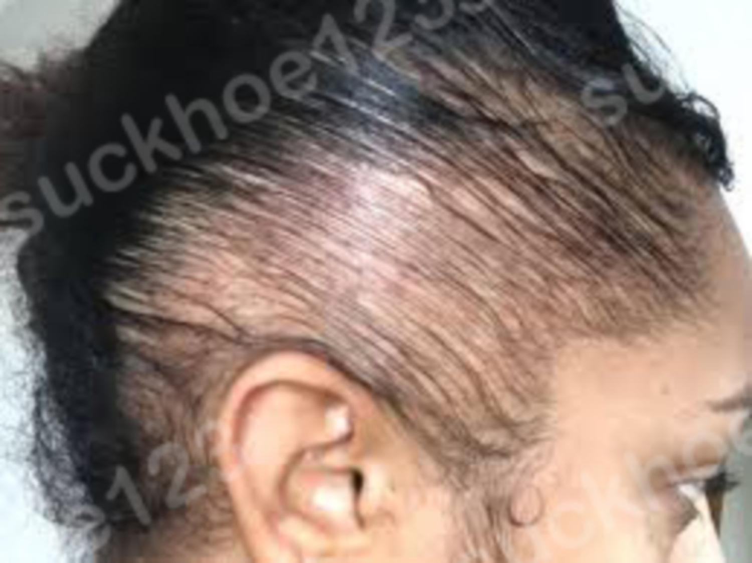 Rụng tóc do lực kéo