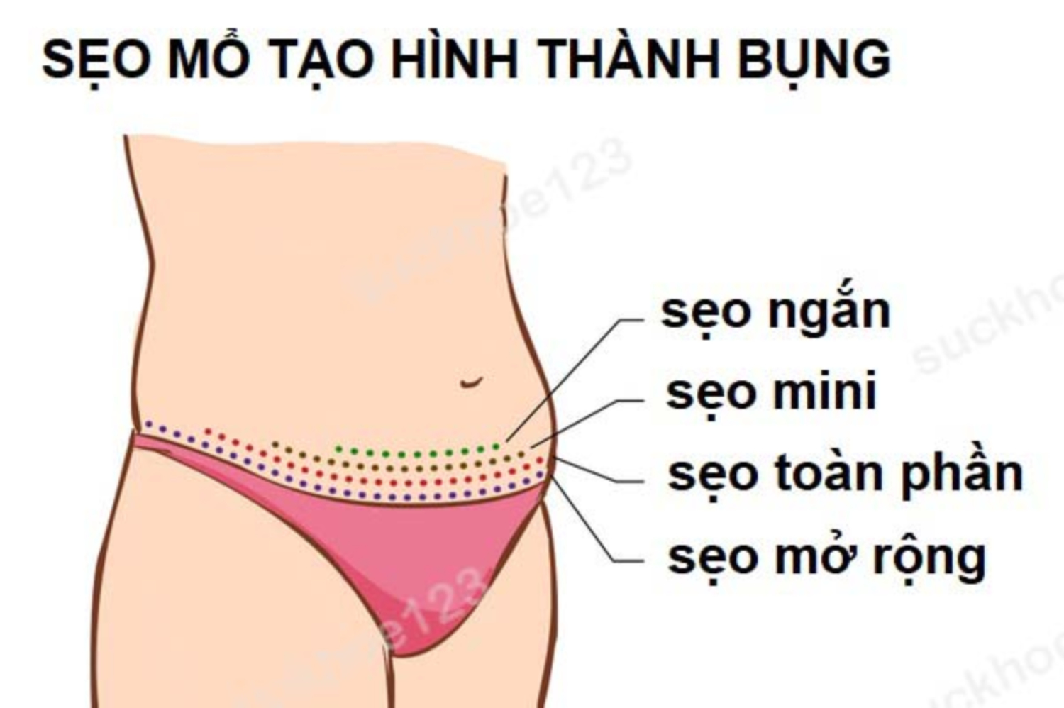 Hình dáng vết sẹo mổ sau tạo hình thành bụng trông như thế nào?
