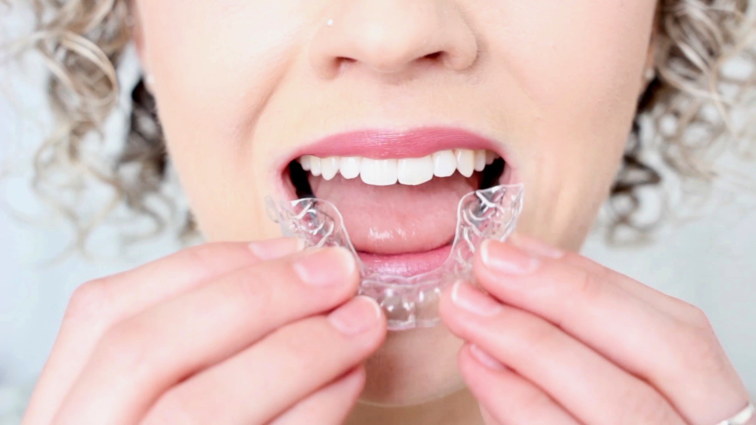 Niềng răng trong suốt Smilelign