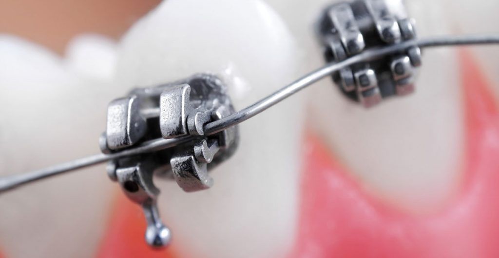 Cách xử lý các sự cố khi niềng răng
