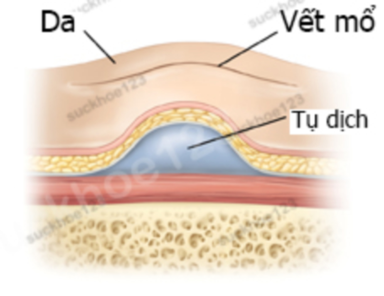 Tụ dịch sau tạo hình thành bụng