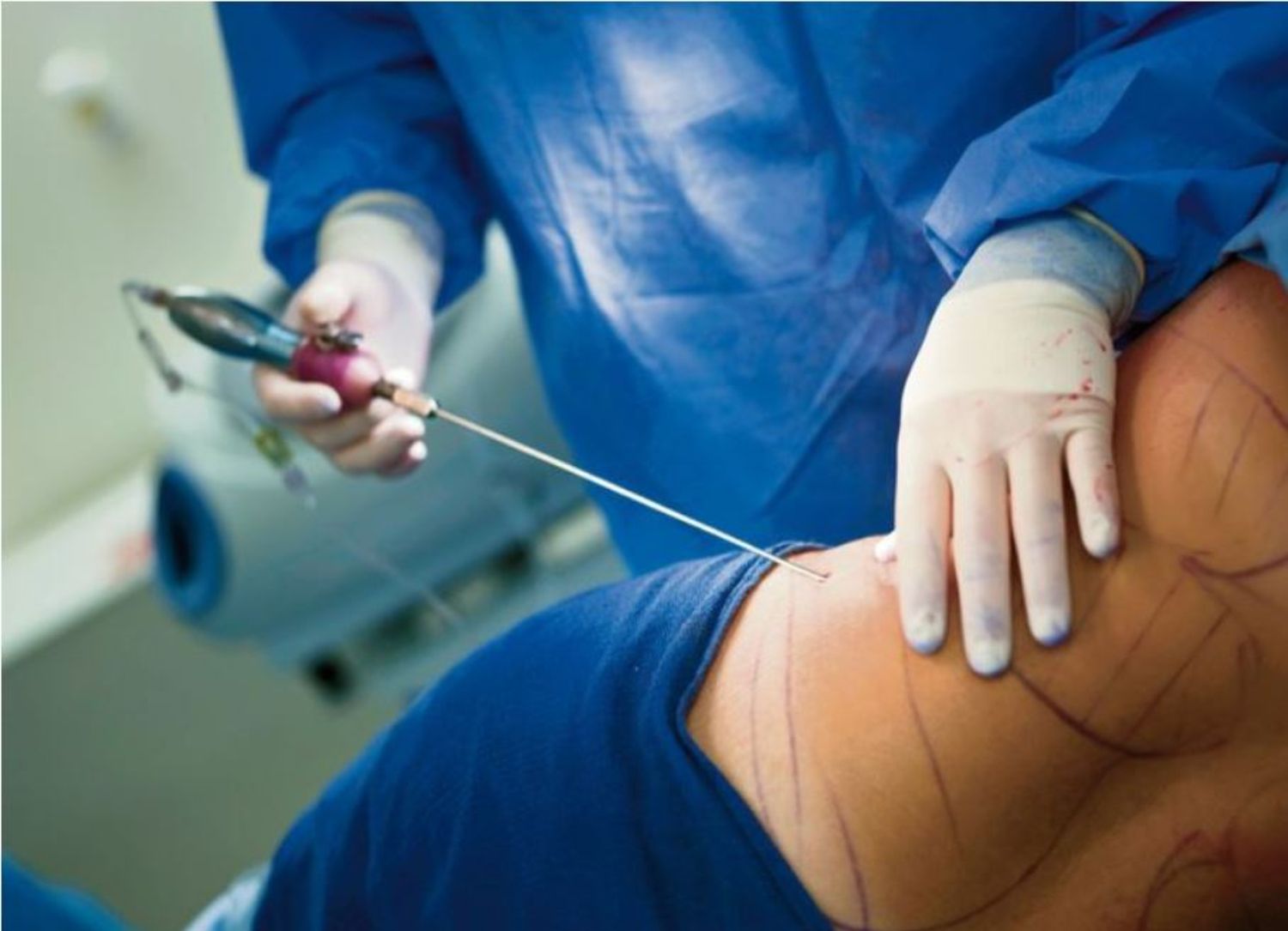 Sưng nề sau hút mỡ: nguyên nhân và cách xử lý