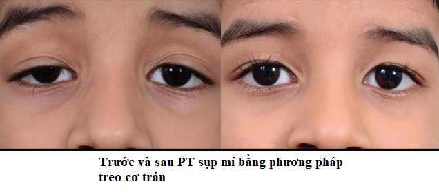 Phân biệt sụp mí và da mí mắt chảy xệ