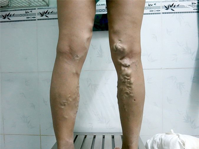 Những câu hỏi thường gặp về suy tĩnh mạch chi dưới