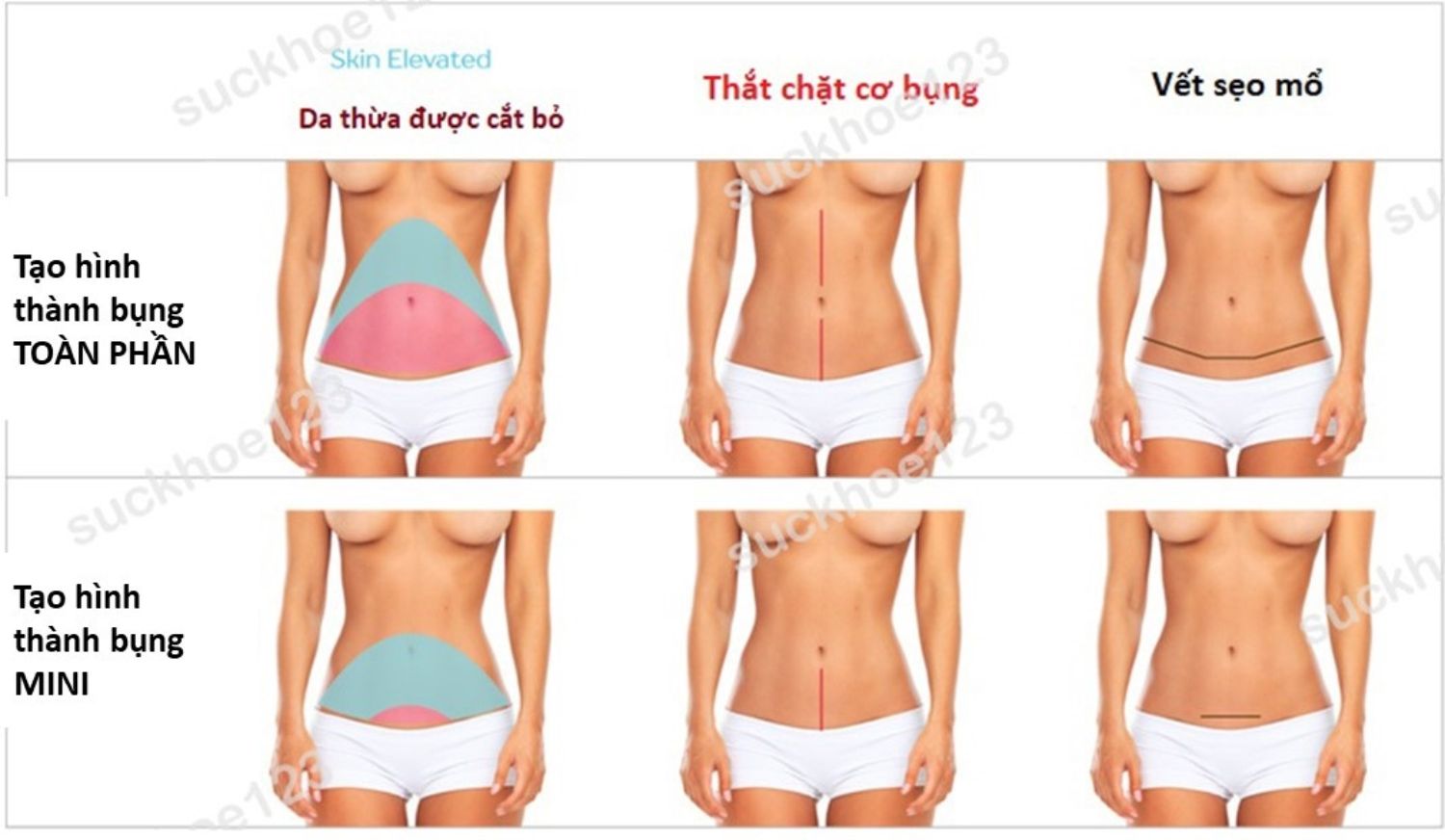 Tạo hình thành bụng mini