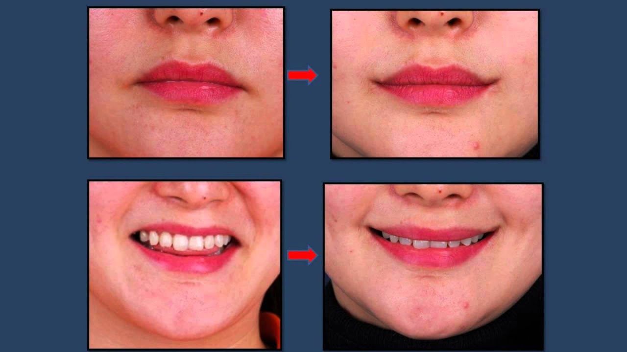 Cách Tạo Khóe Môi Cười: Quy Trình Và Lưu Ý Không Thể Bỏ Qua