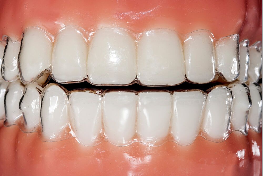 Các lựa chọn thay thế cho niềng Invisalign