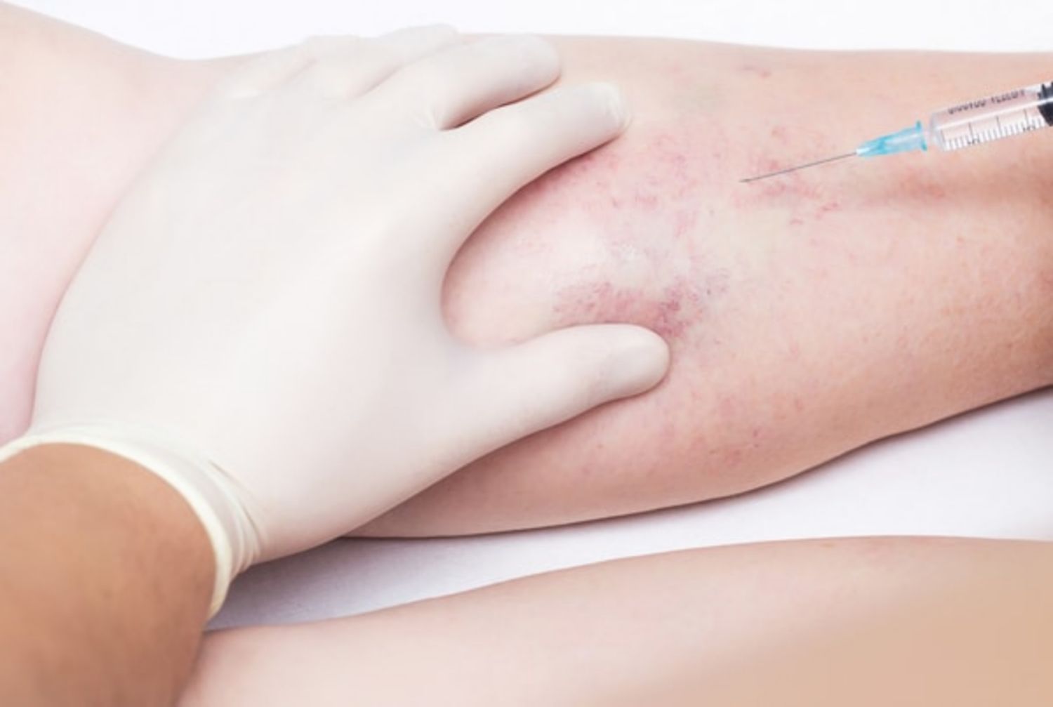Tiêm xơ tĩnh mạch trong điều trị tĩnh mạch mạng nhện