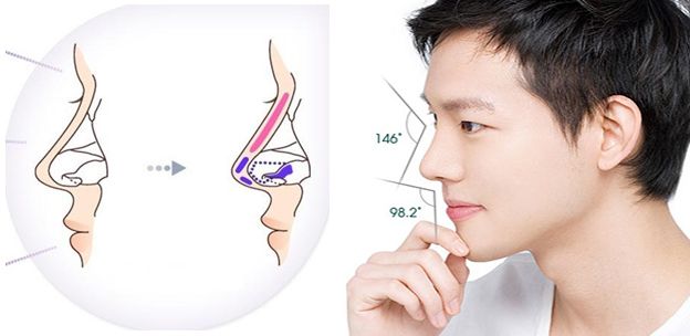 Nâng mũi ở nam giới như nào là đẹp?