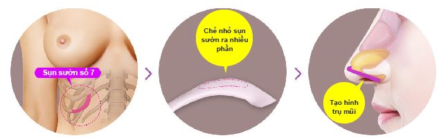 Tìm hiểu kỹ về phương pháp nâng mũi cấu trúc sụn sườn