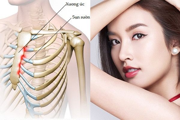 Sụn Sườn – Vật Liệu “Vàng” Trong Nâng Mũi