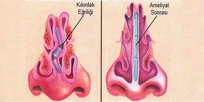 Khắc phục biến chứng mũi lệch sống, nhọn đầu mũi sau nâng ra sao?