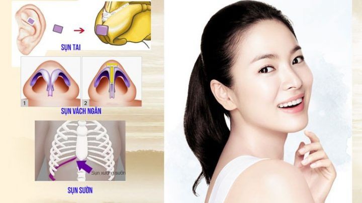 Nâng mũi duy trì kết quả được bao lâu?