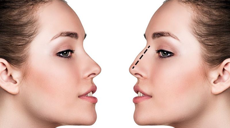 Bàn về tính an toàn trong phẫu thuật thẩm mỹ nâng mũi